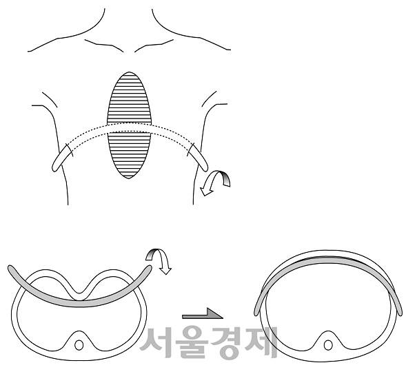 박형주 교수의 오목가슴 수술법. 오목가슴 수술은 옆구리에 2개의 구멍을 뚫고 갈비뼈 안쪽에 활처럼 휜 교정막대를 집어넣어 옴푹 들어간 갈비연골 등을 정상 위치로 높여준다.  /그림제공=박형주 교수
