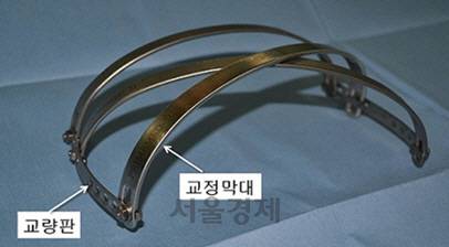 박형주 교수가 개발한 오목가슴 교정용 교량판과 교정막대.