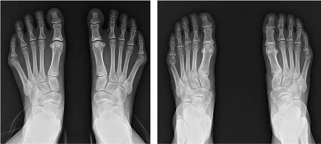 왼쪽부터 수술 전과 수술 후 모습.