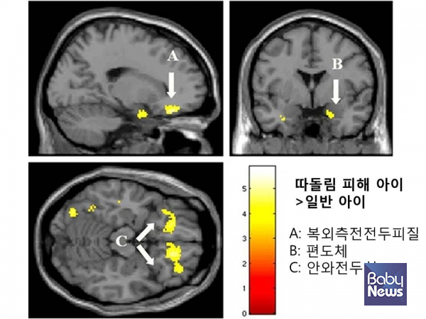 따돌림 피해를 받은 아이의 뇌.&nbsp;ⓒ김영훈