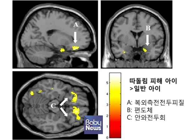 따돌림 피해를 받은 아이의 뇌.&nbsp;ⓒ김영훈