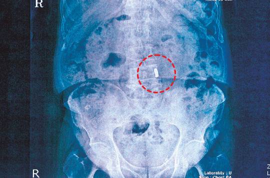 이용만 장로의 척추 좌측에 박힌 인민군 총알(점선 원내). 1951년 왼쪽 어깨 총상 당시엔 몰랐고 20년쯤 지나 재무부 이재국장 시절 발견했다. 2014년 촬영한 엑스레이 사진.