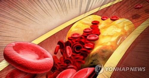 콜레스테롤 쌓인 혈관 (PG) [정연주 제작] 사진합성·일러스트