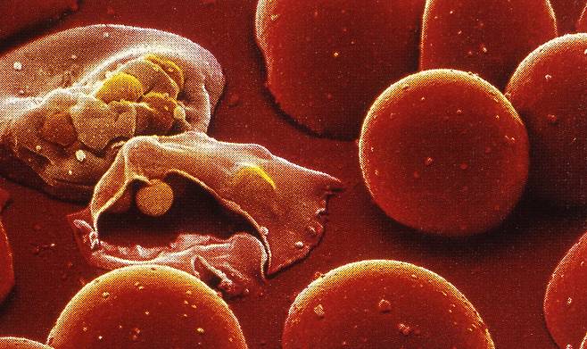 말라리아 원충의 침입과 증식 후 손상된 적혈구 모습. [중앙포토]