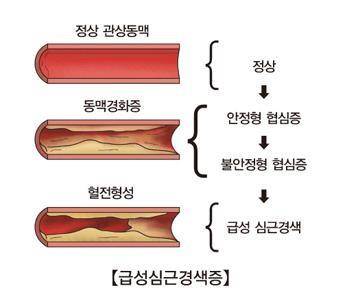 심장마비 경보 [서울아산병원 박덕우 교수 제공]