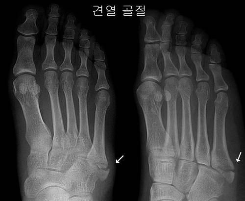 견열골절은 보존적치료만으로 대부분 호전되고 일상생활 복귀도 한층 쉽다.