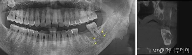 사례1. 골수염환자의 영상/사진제공=메디파트너치과