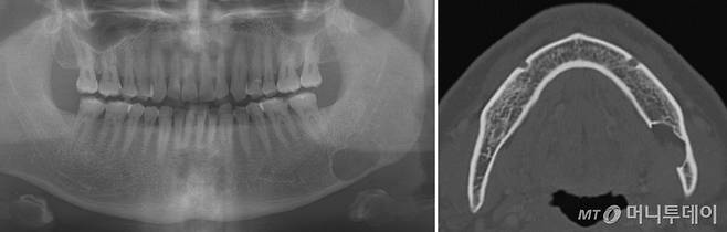 사례2. 하악골 설측 함요 환자의 영상/사진제공=서울대치과병원