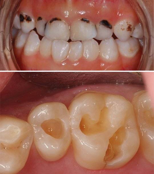 심한 충치(위)와 충치를 치료한 후의 모습(아래). [사진 유원희]