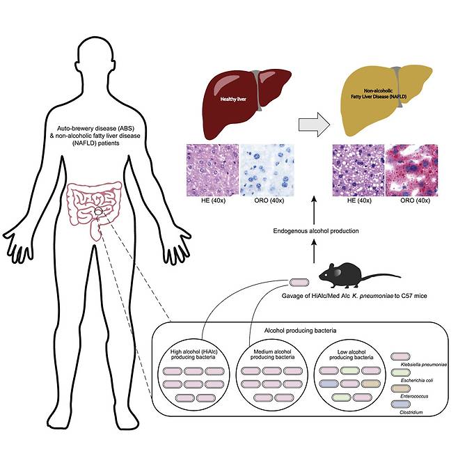비알콜성지방간과 장내미생물간 상관관계 - 셀 메타볼리즘 제공