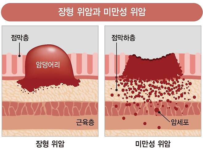 장형 위암과 미만성 위암. [자료 강동경희대병원]