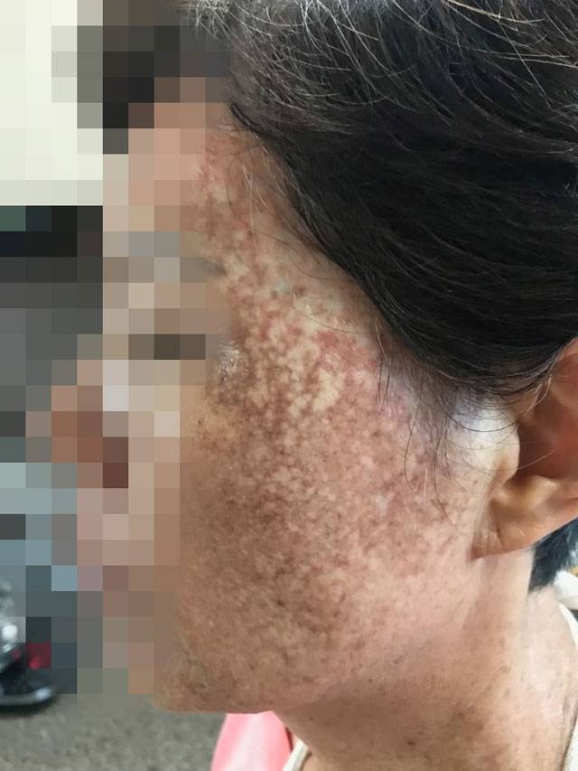 헤나 염색약의 부작용으로 얼굴이 검게 변한 60대 여성 A 씨