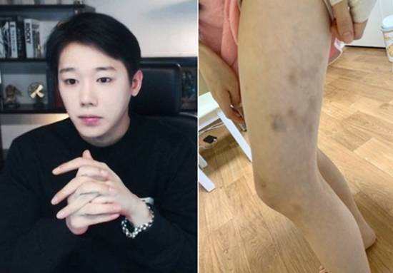 BJ찬(왼쪽)과 피해자가 공개한 상처 사진. 아프리카TV, 궁금한이야기Y 방송 캡처