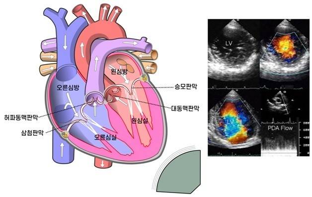 오른쪽 그림: 심장의 구조와 피의 흐름(화살표 방향). 왼쪽 그림: 도플러 초음파 검사기로 피의 흐름의 색깔로 나타낸 심장 영상 (일부 그림 출처: Wikimedia Commons)
