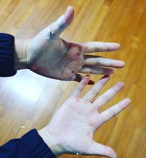 투구와 타격 훈련으로 물집이 생기고 굳은 살이 박힌 김라경 손바닥. [사진 김라경 SNS]