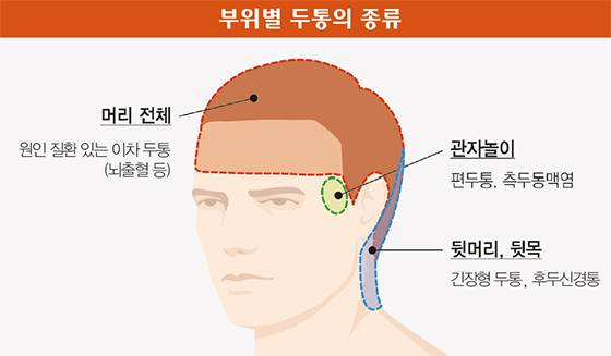 두통은 워낙 종류가 다양하기 때문에 환자가 호소하는 통증 양상에 근거해 진단할 수밖에 없다. 머리 어떤 부분이 아픈지 파악하는 것이 진단에 중요 실마리가 된다.​ <강동경희대병원 제공>