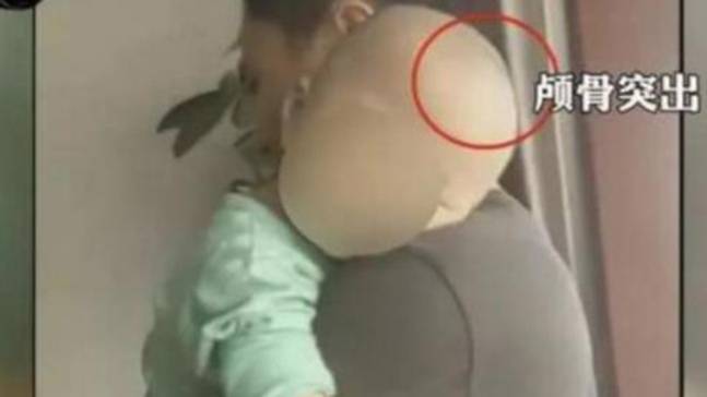 중국서 가짜 분유로 유아 머리 인형처럼 커져 - 신경보 캡처