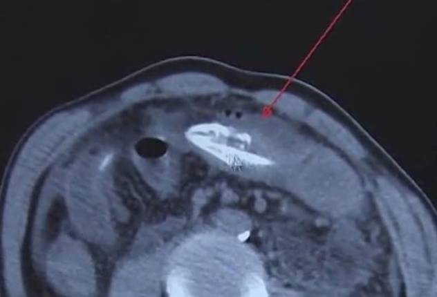 오랜 변비를 치료하기 위해 살아있는 장어를 몸에 집어넣은 중국의 50대 남성환자의 엑스레이 사진