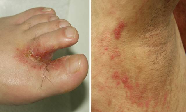 발가락 사이와 겨드랑이 부위에 생긴 무좀(족부 백선)과 간찰진(접촉성 피부염)./사진제공=노원을지대병원