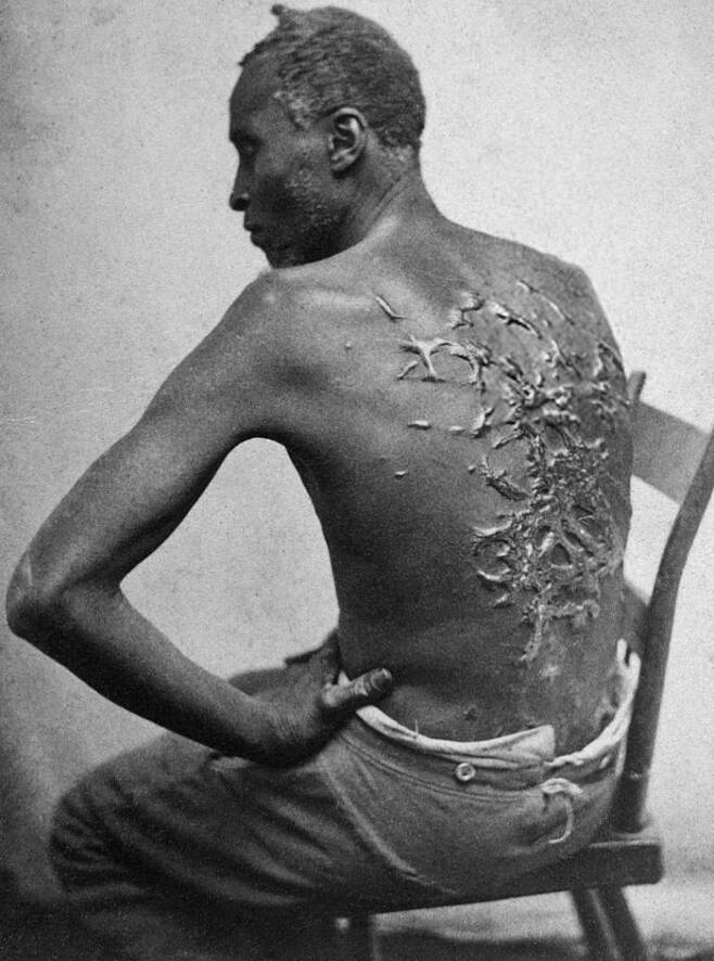 흑인 노예 고든의 사진(1863년)