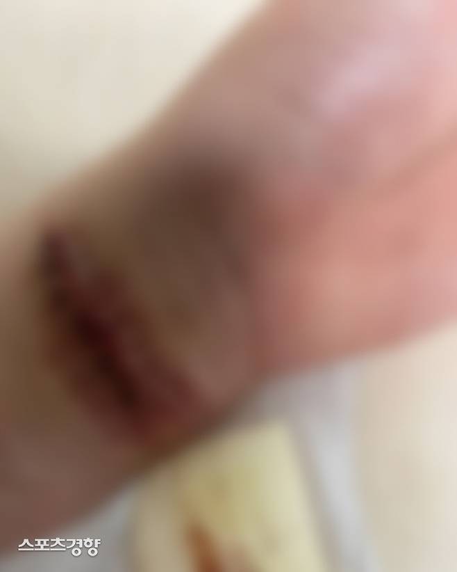 AOA 출긴 권민아가 6일 올린 자해 흔적이 담긴 손목 사진. 권민아 인스타그램