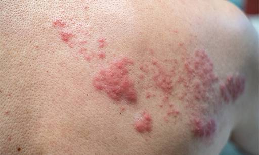 체력 저하 등으로 면역력이 떨어지는 요즘 대상포진 재발을 조심해야 한다. 의료계에서는 “대상포진은 적극적인 치료가 필요한 질환”이라며 “한양 복용 등으로 저하된 회복력을 올리는 것이 병의 치료와 재발 방지에 도움이 될 것”이라고 설명했다. 게티이미지뱅크