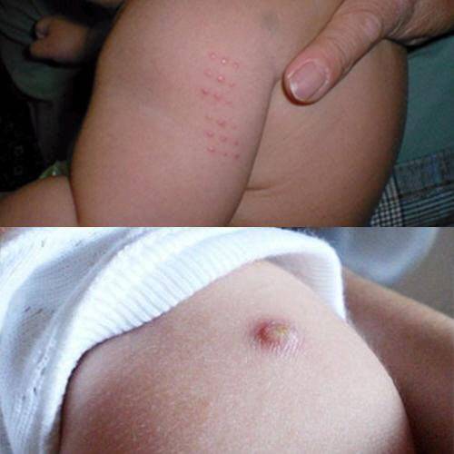 경피용(위)와 피내용(아래) BCG백신. (사진=보건복지부)