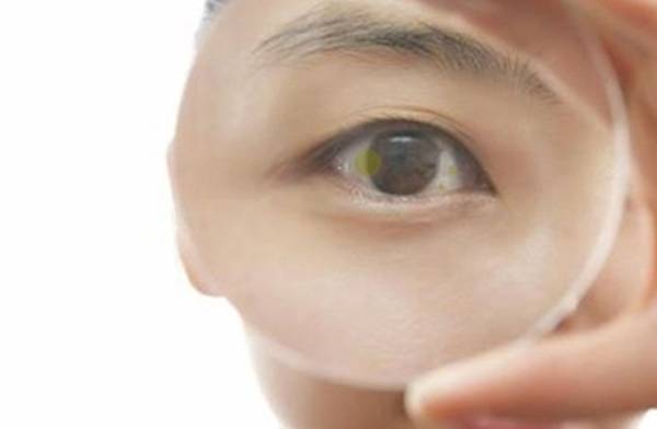 눈에 노란 반점을 띠는 '드루젠'이 있다면 뇌 혈류 감소를 의심할 수 있다./사진=헬스조선 DB