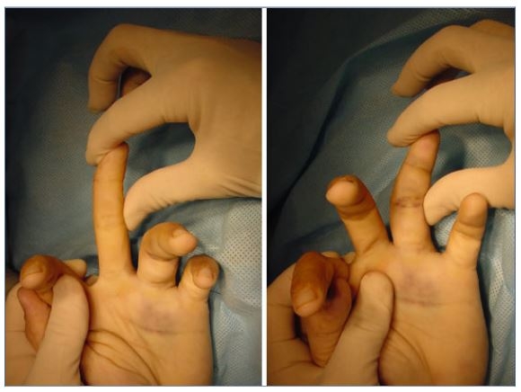손가락 측부 인대 손상 시 정상의 손가락은 좌우로 압력을 가해도 휘어지지 않지만(왼쪽), 인대 손상 환자의 경우 쉽게 휘어진다(오른쪽). 정동병원 제공