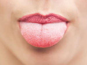 혀에 백태가 자주 낀다면 구강건조증이나 구강칸디다증을 의심해볼 수 있다./사진=클립아트코리아
