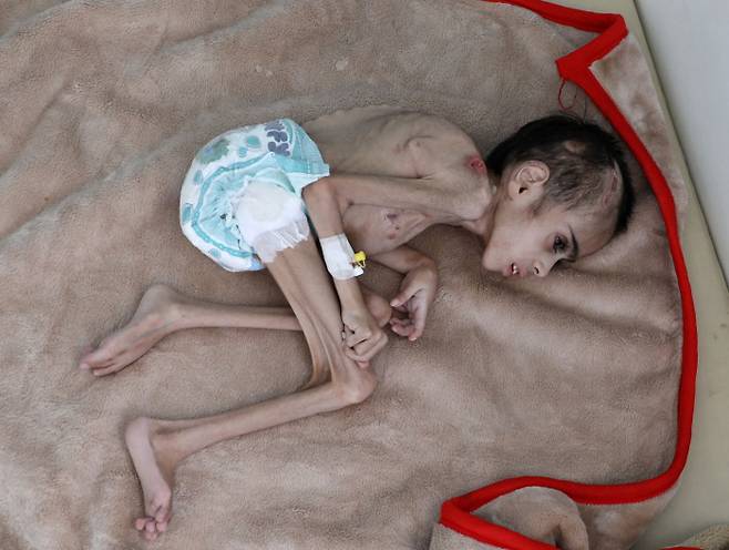예멘 수도 사나의 알 사빈 병원에서 치료를 받고 있는 일곱살 파이드 사밈의 몸무게는 겨우 7kg에 불과하다. 사나｜로이터연합뉴스