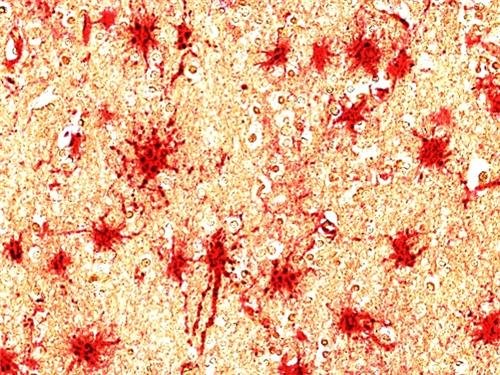 치매환자 뇌의 성상교세포(적색)에서 발현이 증가한 C8-감마 단백질(흑색). [그래픽 석경호·류훈 교수]