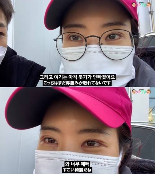 개그우먼 이세영이 쌍꺼풀 수술 후 실밥을 제거한 모습을 공개했다. 사진=이세영 유튜브 캡쳐