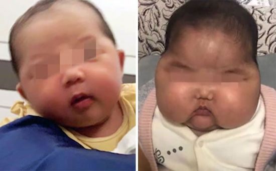 중국에서 특정 아기 크림을 바른 일부 아기들이 얼굴이 비정상적으로 붓고 체중이 늘어나는 등 이상 증상을 겪었다. 사진출처 = 연합뉴스