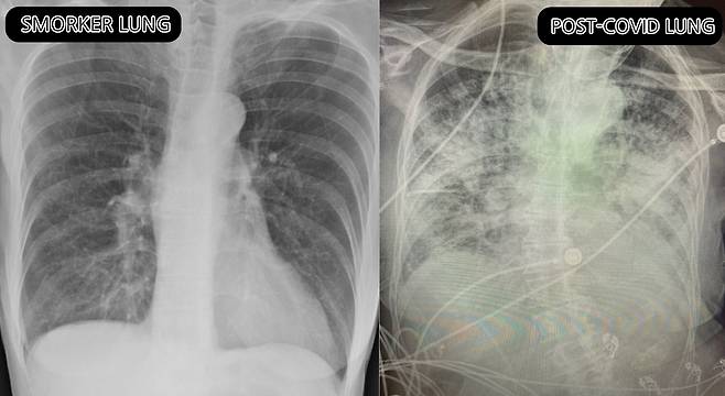 브리트니 뱅크헤드-켄달 박사가 제공한 폐 엑스레이 사진. 흡연자의 폐(왼쪽)과 코로나 바이러스 감염자의 폐. 엑스레이 상에서 폐의 검은 부분은 공기를 나타내고 흰 부분은 상처나 충혈된 부분을 뜻한다. 트위터 캡처