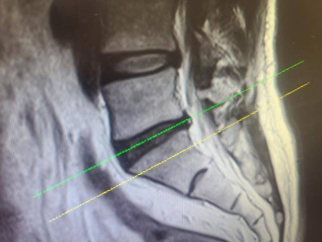 퇴행성으로 디스크가 손상(녹색)되 튀어나와 뒷쪽 신경을 누르고 있어 통증을 유발한다. 이 부부의 경우 윗쪽 디스크와는 달리 퇴행이 진행되서 검은색이 진하게 보인다. 김민규 기자 whitekmg@hankookilbo.com