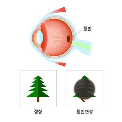 황반변성. /서울삼성병원