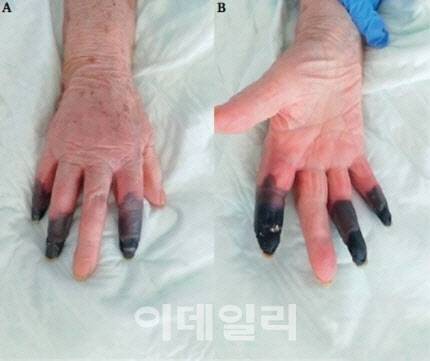 노인의 괴사된 손가락. (사진 = the European Journal of Vascular and Endovascular Surgery)