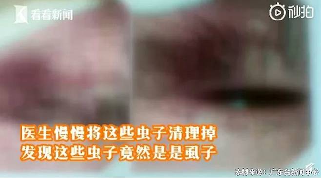 할머니의 속눈썹 뿌리 부분에 있는 40마리가 넘는 ‘이’. PPTV 캡처