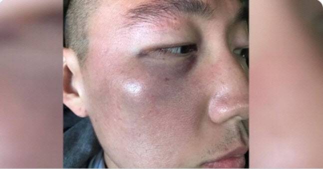 미국 내 아시아계 증오 범죄 폭행 사건의 피해자인 한국계 데니 김씨. (출처=데니 김 트위터, 연합뉴스 제공)