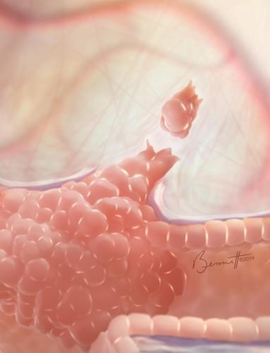 유방암 종양에서 분리되는 CTCs 이미지 [미 존스홉킨스의대 제공 / 재판매 및 DB 금지]