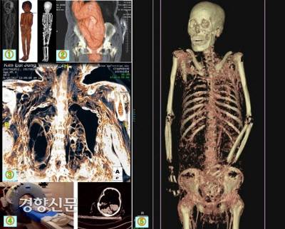 조선시대 미라의 최첨단 분석 과정. ‘소년 미라(윤호)’의 일반방사선 전신 사진, 실제 전신 사진, 컴퓨터단층촬영 후 뼈에 대한 3차원 모델 사진(①)과 ‘파평 윤씨 모자 미라’의 3차원 복원 영상(②), ‘김의정(가칭) 미라’의 폐사진. 왼쪽 폐에서 낭성병변이 보인다(③), ‘진성이낭 미라’의 CT 촬영결과 뚜렷하게 확인되는 뇌 사진(④), ‘학봉장군’ 미라의 3차원재형성 사진. |김한겸 교수·단국대박물관 제공