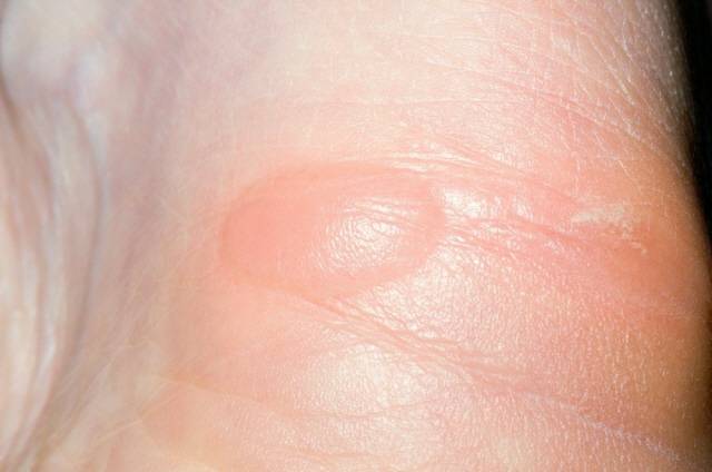 발에 생긴 물집을 함부로 터뜨리면 2차 감염 위험이 있다./클립아트코리아