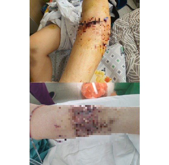 지난 2월 7일 발생한 개물림 사고로 이모(29)씨는 팔과 다리에 총 6번의 수술을 받았다. 피해자 제공