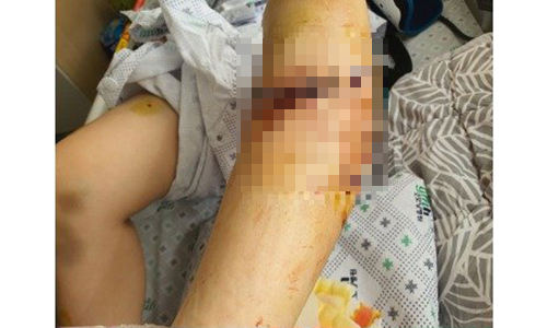 지난 2월7일 발생한 개물림 사고로 A씨는 팔과 다리에 총 6번의 수술을 받았다. 피해자 제공/중앙일보