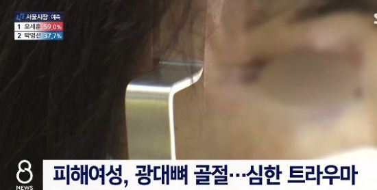 묻지마 폭행으로 피해 여성은 광대뼈 골절 등 피해를 입었다. / 사진=SBS 방송 캡처