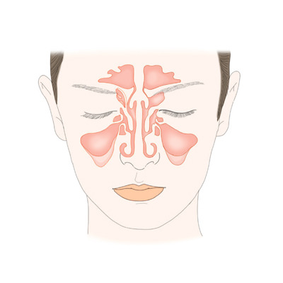 부비동염(축농증) [출처: 삼성서울병원]