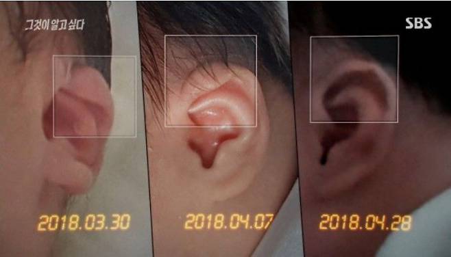 SBS '그것이 알고싶다'가 지난 10일 방송에서 공개한 보람양의 왼쪽 귀 사진. /SBS