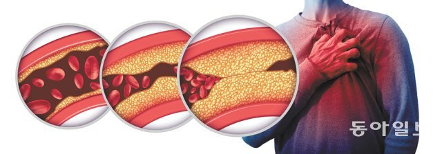 이상지질혈증은 이 질환 자체로도 문제지만 대사증후군으로 이어질 수 있어 주의해야 한다. 이상지질혈증이 중증으로 진행되면 합병증도 발생할 수 있다. 평소 꾸준한 관리와 치료가 중요하다. 동아일보DB