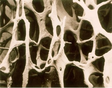 골다공증 뼈의 단면을 확대해 보면 구멍이 많고 커서 앙상한 나뭇가지 모양이다. 중앙포토
